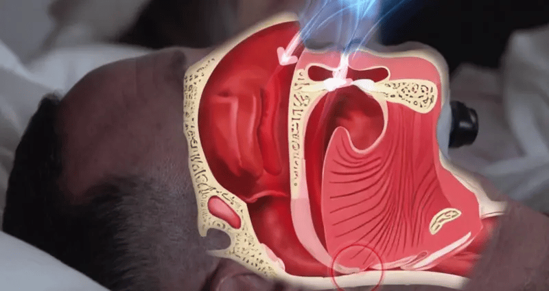 ZeroSnore™ — tecnologia comprovada, sem truques